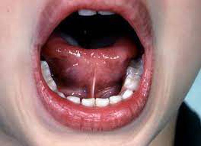 Ankyloglossia