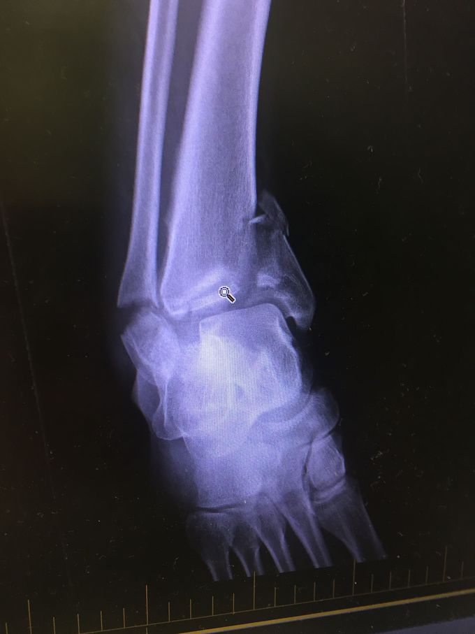 Tib/Fib Vs. Motorbike