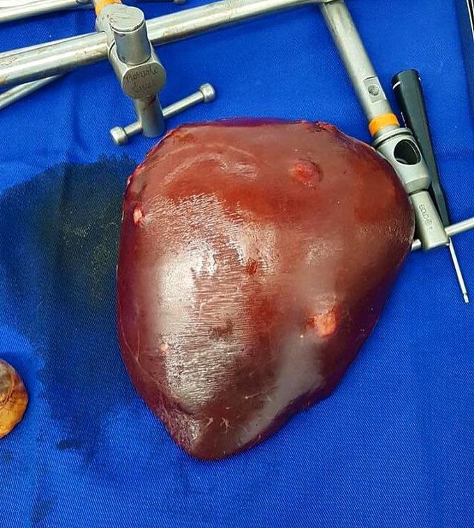 A right hepatectomy with multiple colorectal metastases! 