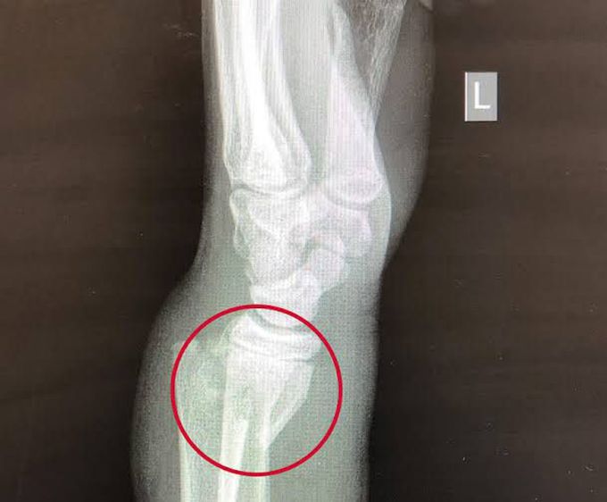 Smiths fracture