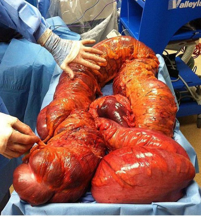 One massive Toxic Megacolon!