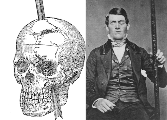 Phineas Gage: A Case Study in Brain Injury and Personality Change