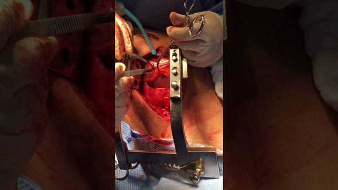Cardiac tamponade