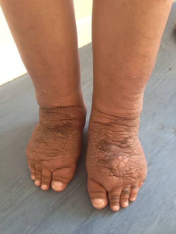 Myxoedema