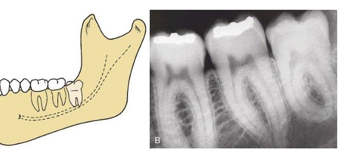 Vertical impaction