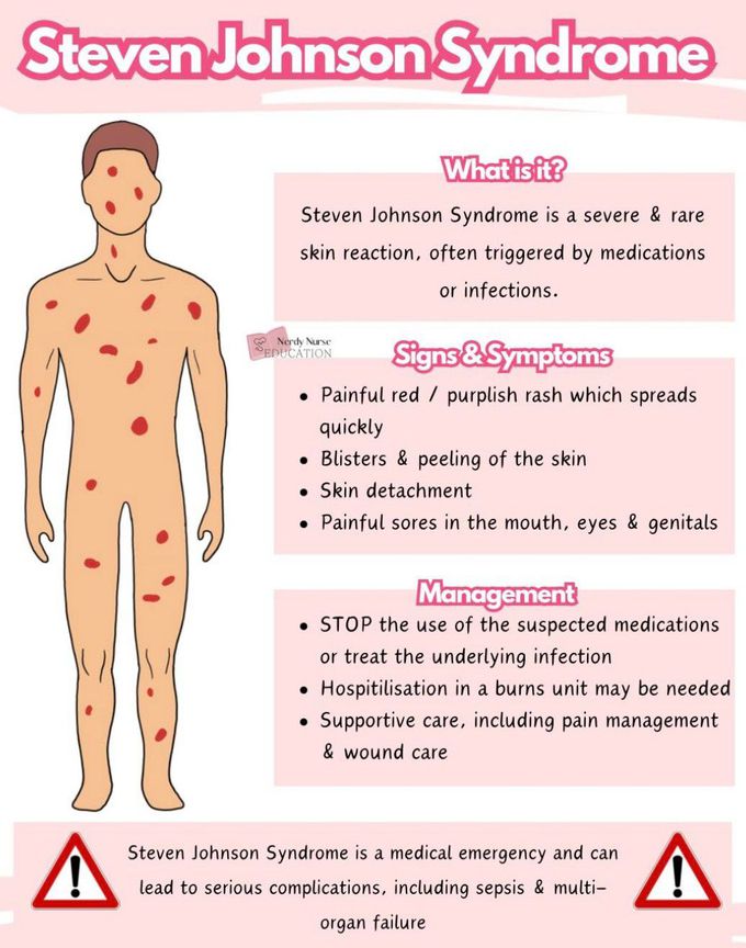 Steven Johnson Syndrome