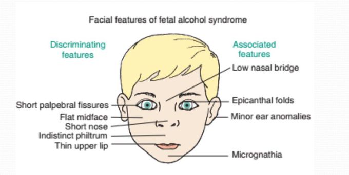Fetal Alcoholic Syndrome