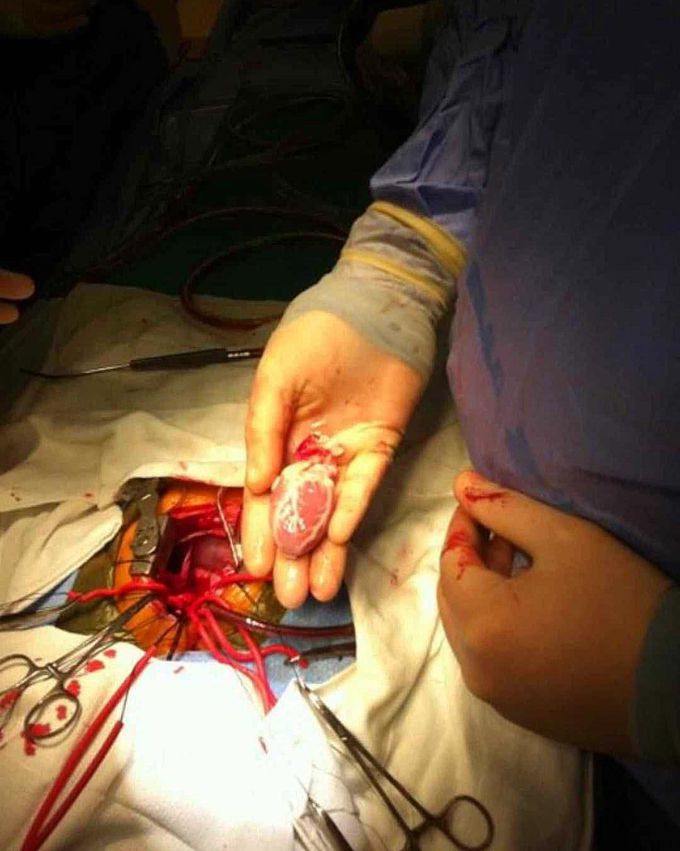 Smallest heart transplant! 