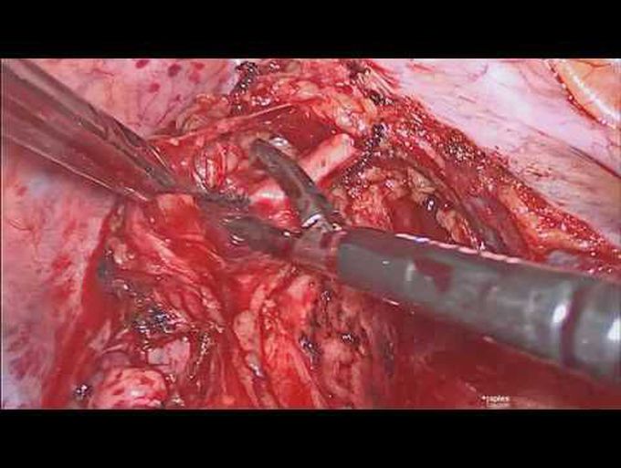 The Recurrent Laryngeal Nerves and the Thoracic Surgeon