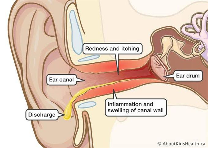 How is otitis externa treated?