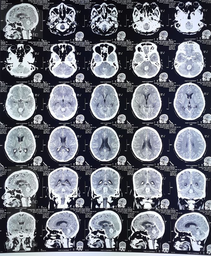 Ct scan with contrast