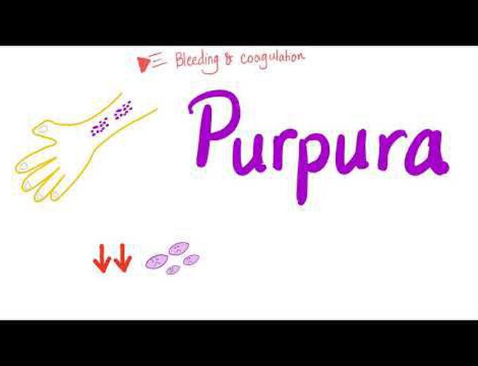 Pupura | Bleeding Disorders