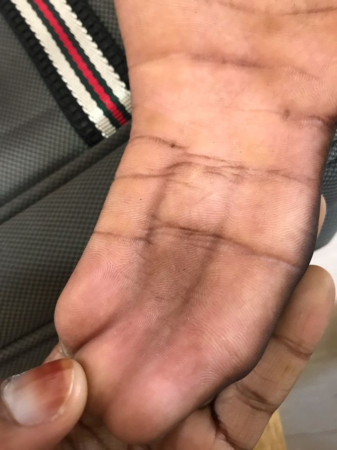 Case of syndactyly