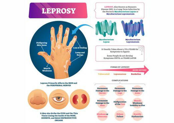 Leprosy