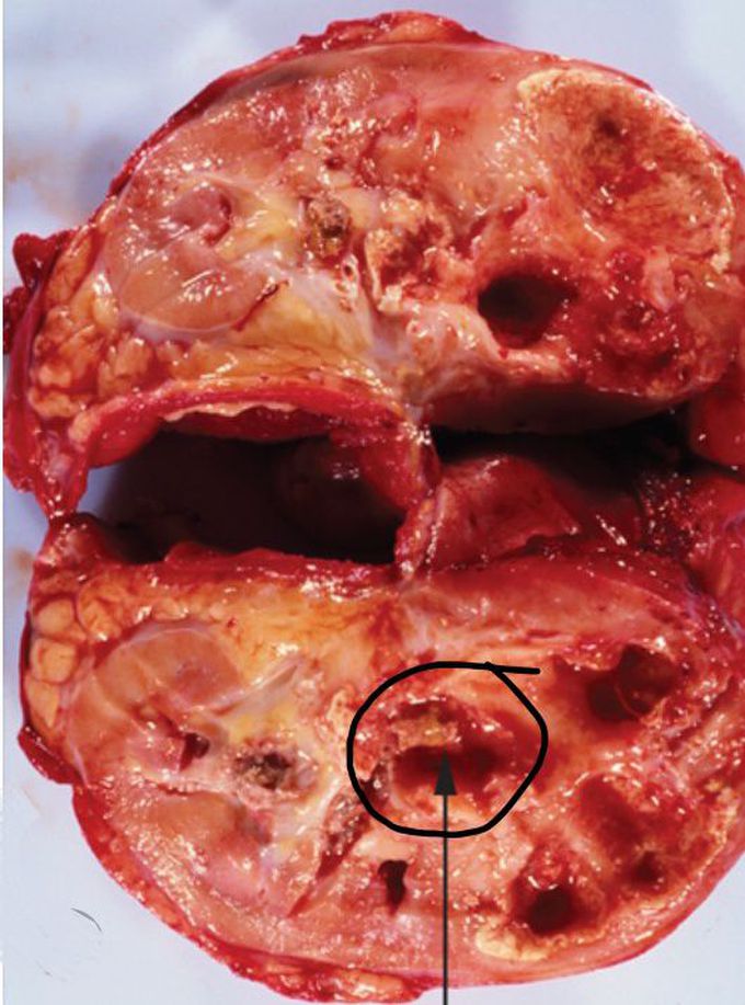 Can you name the infection?