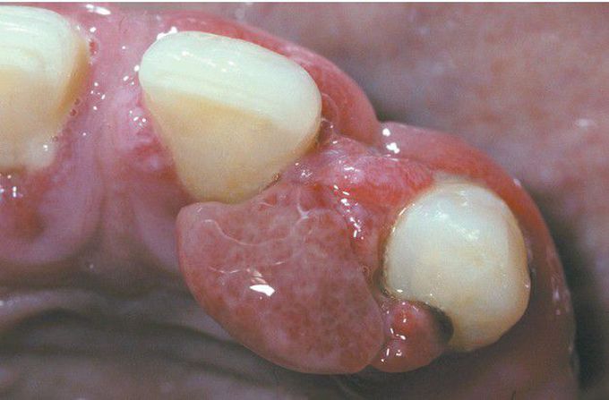 Pyogenic Granuloma.