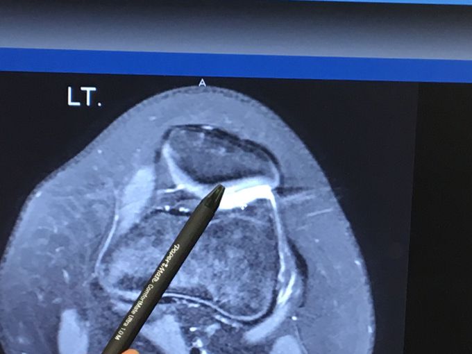 deterioration of cartilage (Pediatric)