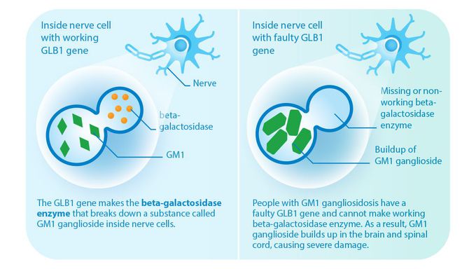 What is GM1 gangliosidosis?