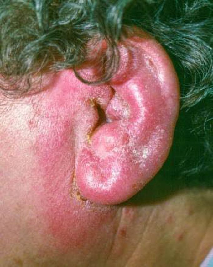 Symptoms of otitis externa