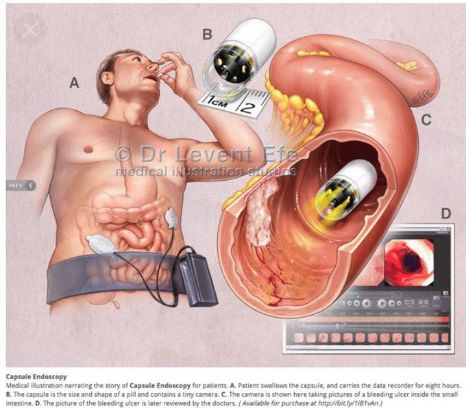 Capsule endoscopy