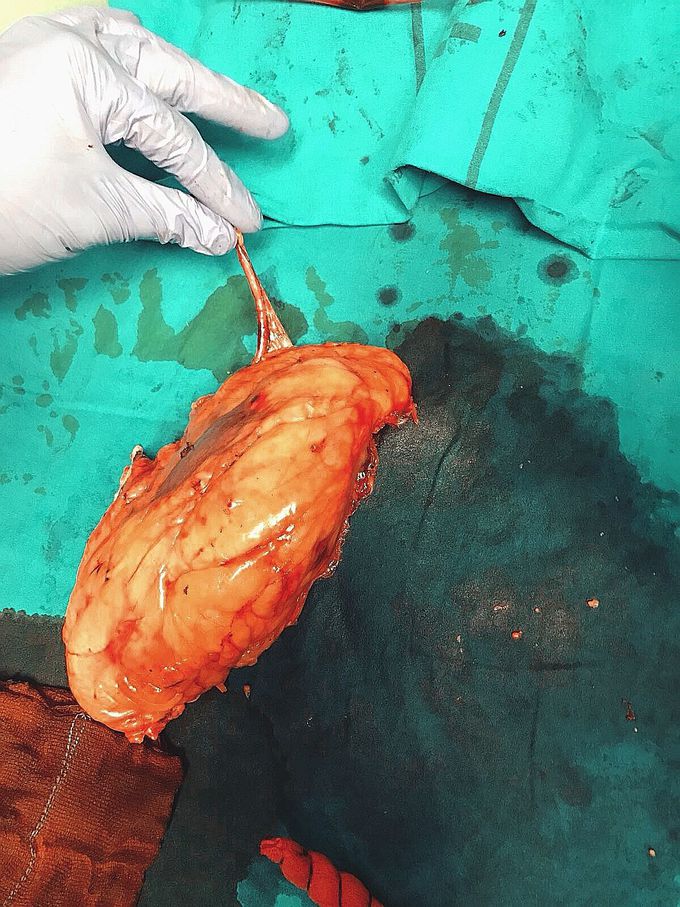 Unilateral nephrectomy due to kidney carcinoma