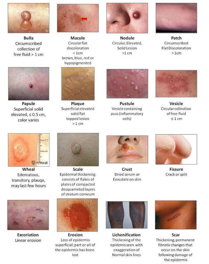 Skin Lesions