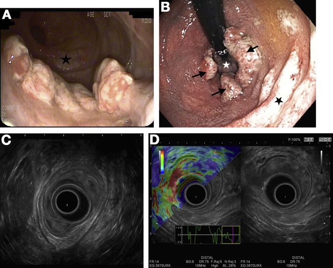 Bleeding Per Rectum Differential Diagnosis