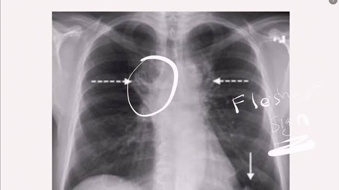 Symptoms of pulmonary embolus