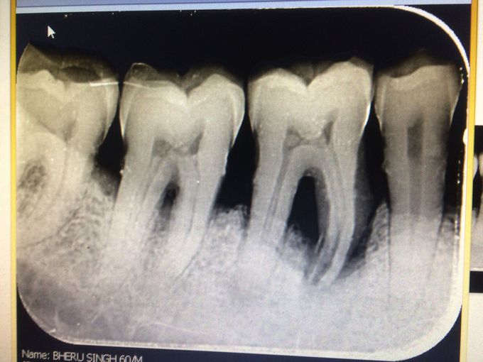 Vertical bone loss