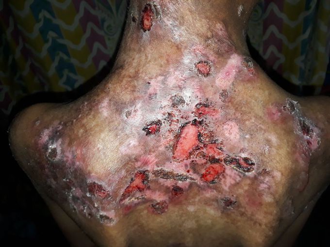 Autoimmune disorder
