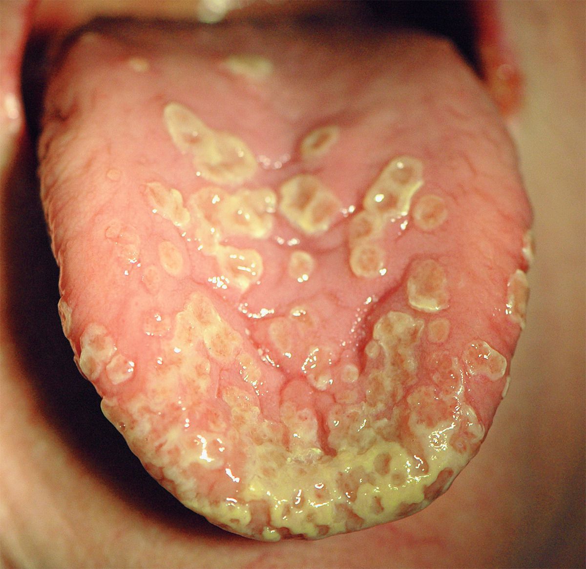 Pyostomatitis Vegetans. - MEDizzy, image size:1200x1166