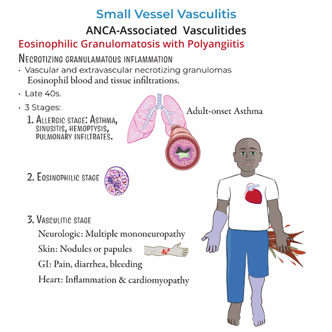 Eosinophilic Granulomatosis With Polyangiitis