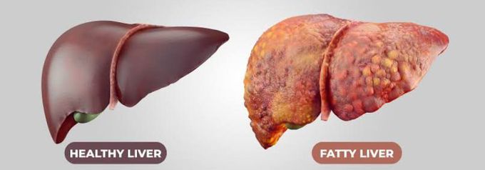 Non alcoholic fatty liver disease