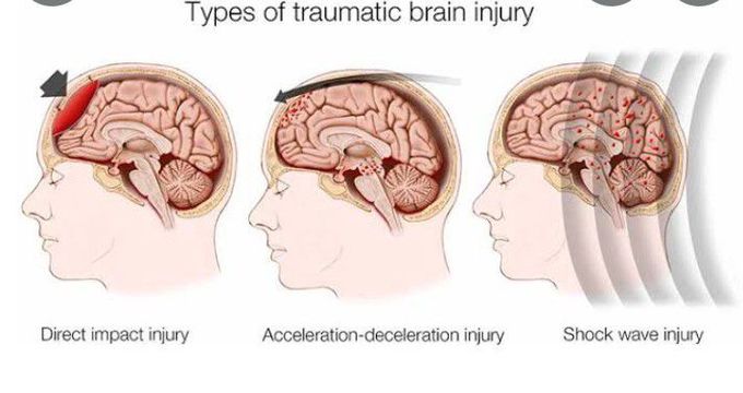 Traumatic Brain Injury (TBI)