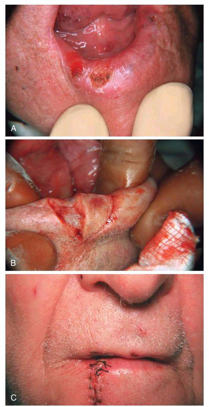 Excisional biopsy