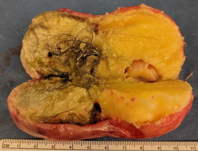Ovarian Cyst
