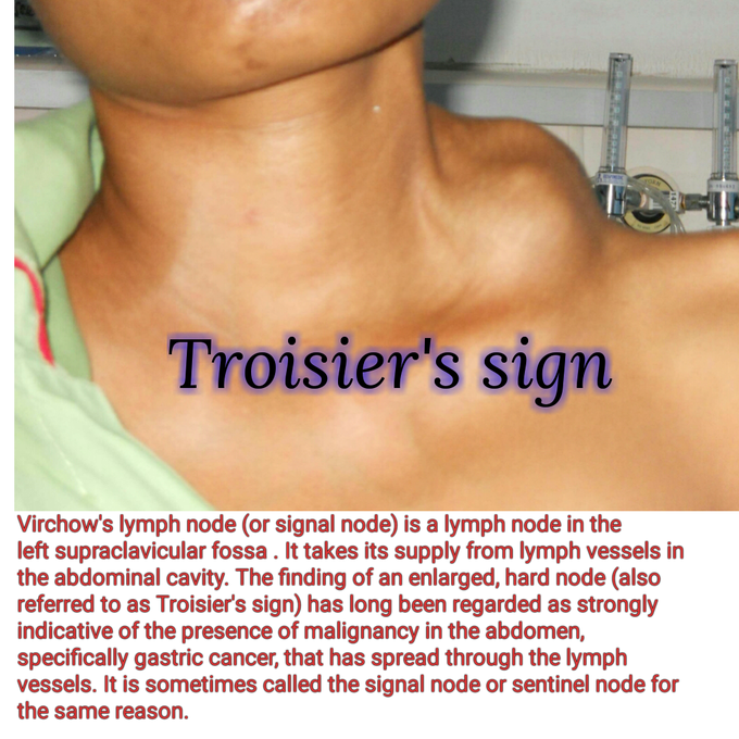 Troisier's sign--- Enlargement of the Virchow's lymph nodes (left supraclavicular lymph nodes)