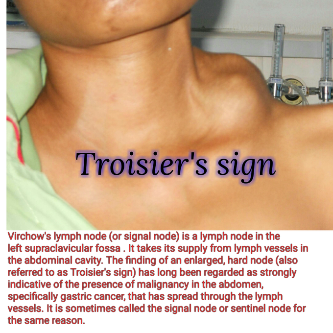 Troisier S Sign Enlargement Of The Virchow S Lymph Nodes Medizzy