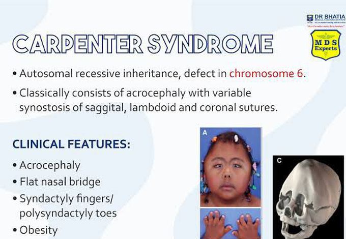 These are the features of Carpenter syndrome