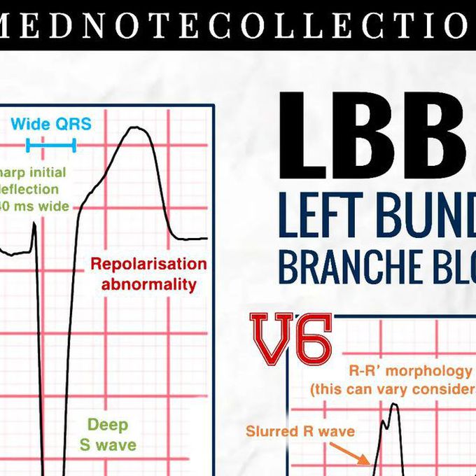 LEFT BUNDLE BRANCH BLOCK (LBBB)