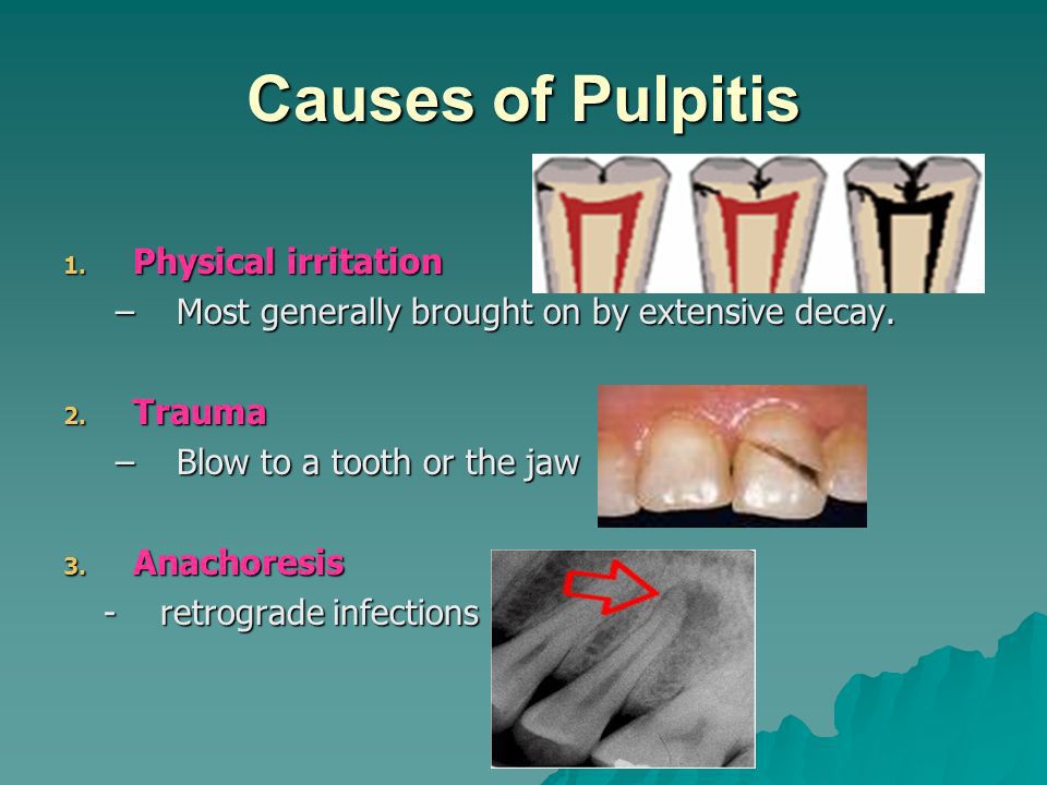 Causes of Pulpitis MEDizzy