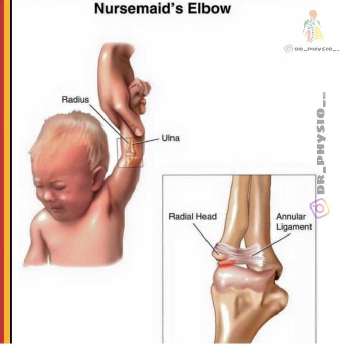 Nursemaid's Elbow