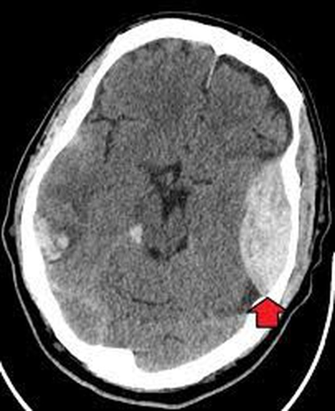 Symptoms of epidural hematoma