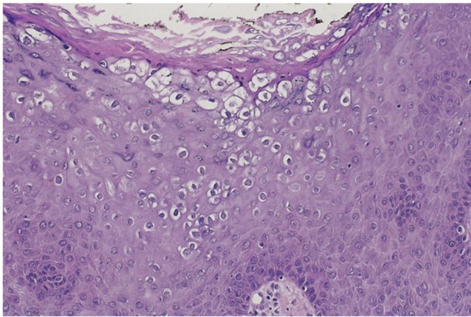 Female reproductive disorders