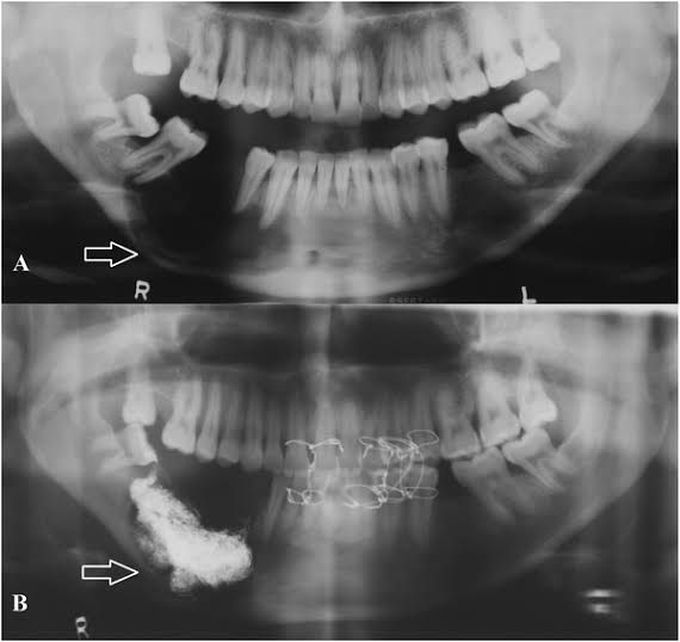 Residual cyst