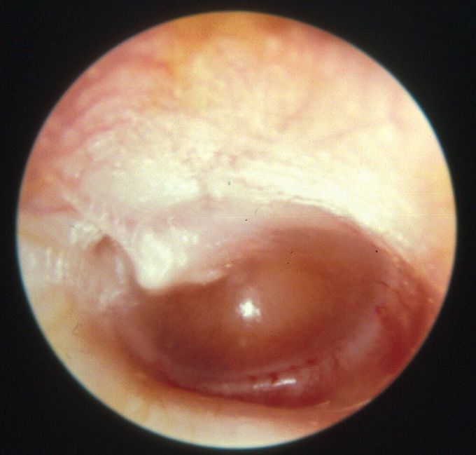 Otitis Media with Effusion