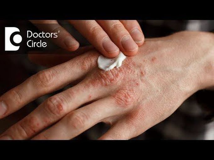 Topical Treatment of Psoriasis
