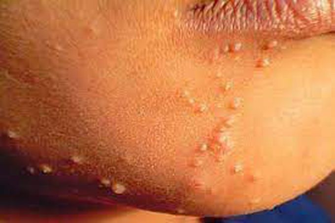 Who is at risk for molluscum contagiosum?