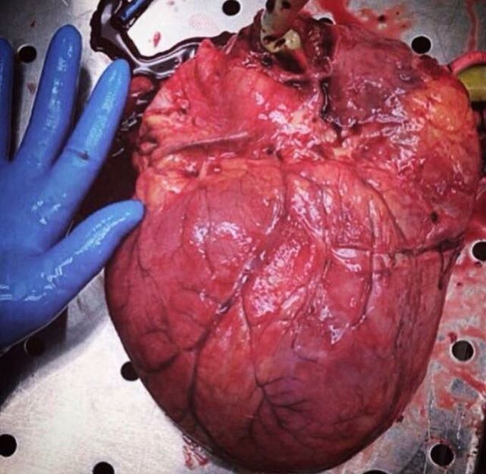 Cardiomegalia