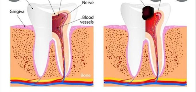 Symptoms of Pulpitis